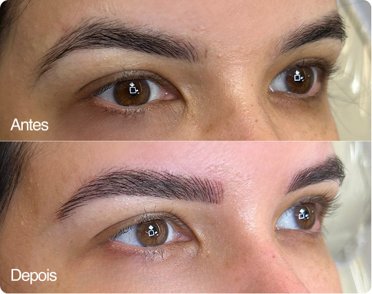 Antes e depois — Técnica Milimétrica Fio a Fio