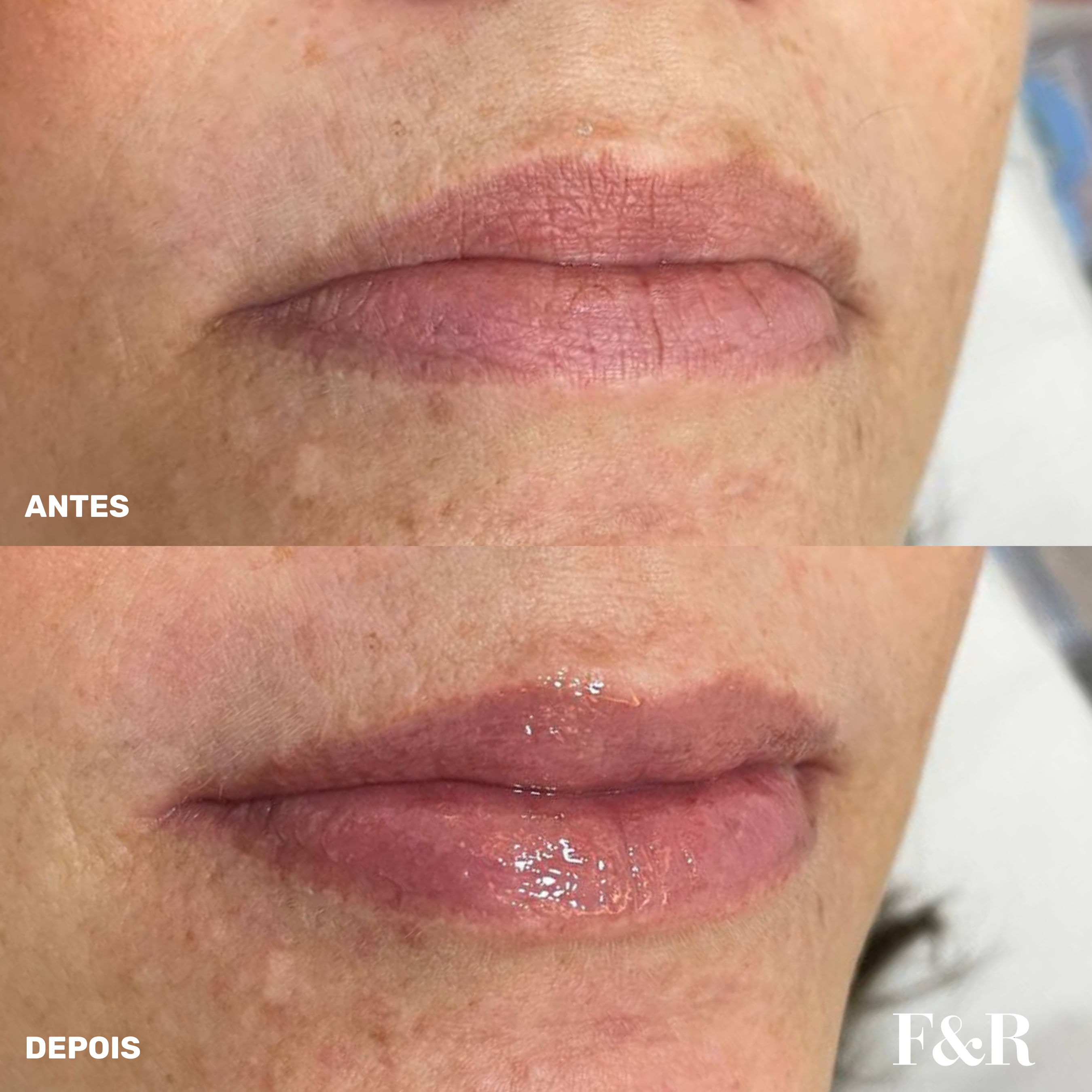 Hydra Lips — antes e depois